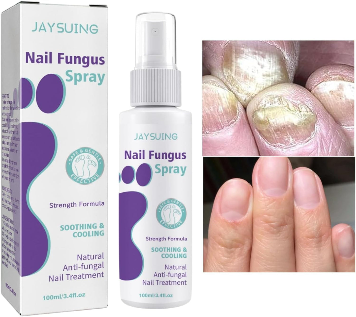 FUNGAL NAIL TREATMENT FOR TOENAILS EXTRA STRONG,100ML SPRAY FOR NAILS